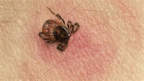 Enfermedad De Lyme Síntomas Y Consejos Para Prevenirla La Nueva España