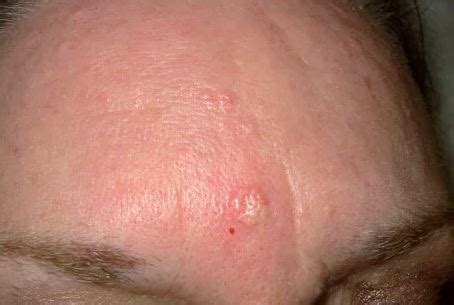 Sebaceous hyperplasia is a very common condition that causes small bumps on the skin. Sebaceous Hyperplasia - Treatment, How To Get Rid, Photos ...