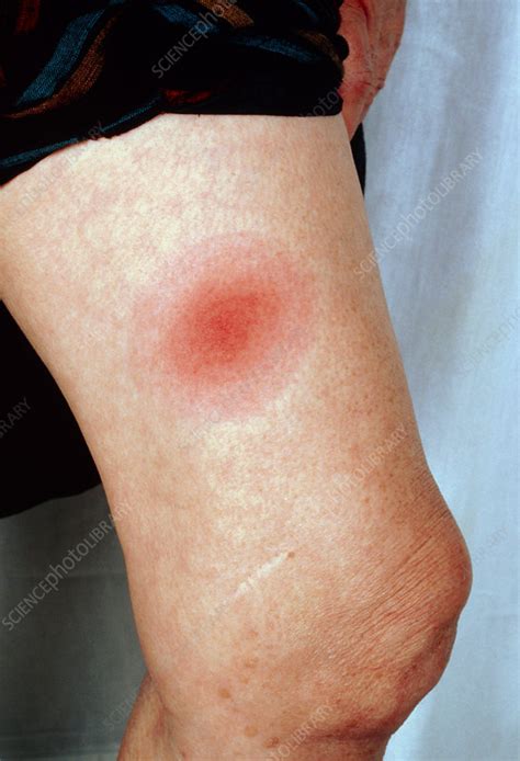 Erythema Migrans Rash On Leg Lyme Disease Stock Image M2000063
