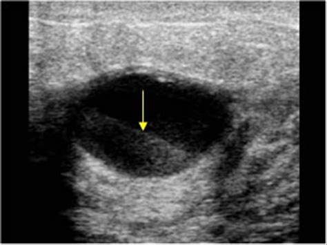 Breast And Axilla 51 Benign Lesions Case 512 Infected Cysts