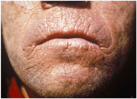 7 Rarest Skin Diseases In The World