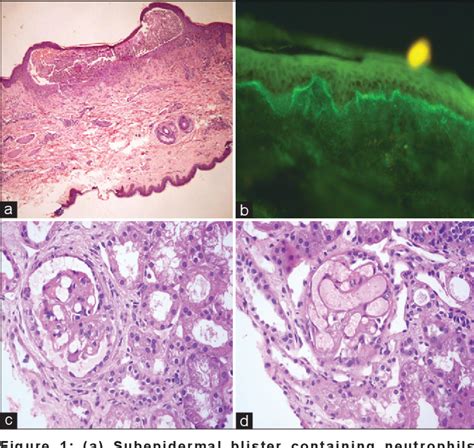 Figure 1 From Systemic Lupus Erythematosus With Linear Iga Bullous