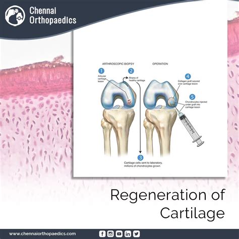 Regeneration Of Cartilage