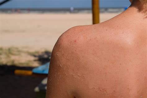 Sonnenbrand Die Skin Cancer Foundation