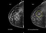 Study finds 3-D mammography more effective at detecting most lethal ...