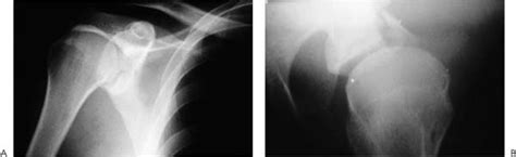 6 Glenoid Rim Fractures Musculoskeletal Key