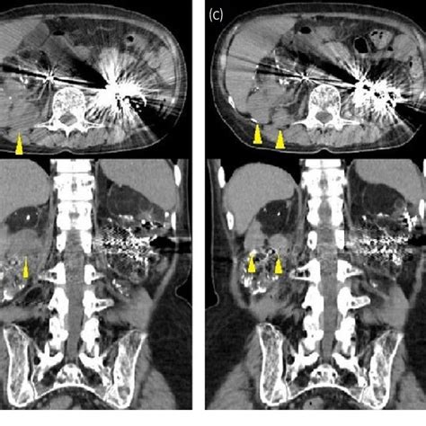 A Ct Scan Showed The Tumor In The Right Femur Arrow B Abdominal