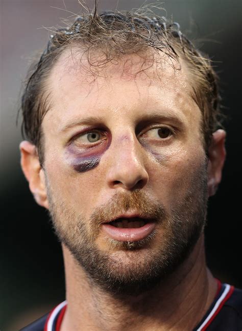 Scherzer has an uncommon condition called heterochromia iridis that affects less than 200,000 people in the united states. Max Scherzer's black eye made for good photos | MLB.com