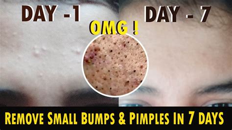 7 Days Challenge Get Rid Of Tiny Bumps On Face Small Head Bumps