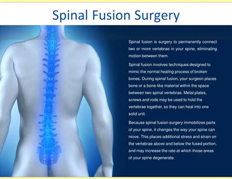 Ppt Spinal Fusion Surgery Powerpoint Presentation Free Download Id
