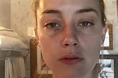 New Photos Show Amber Heard With Other Injuries Allegedly Caused By Johnny Depp