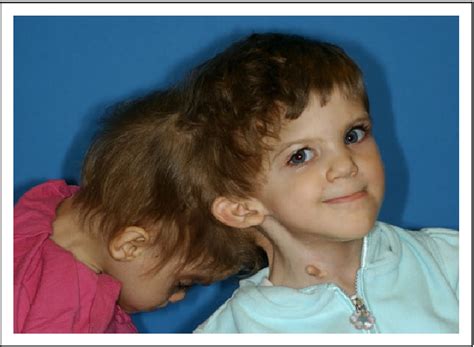 Figure 1 From Eleven Year Follow Up Of Craniopagus Twins After