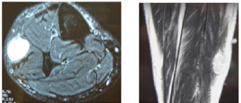 Figure 1 From Schwannoma Of The Superficial Peroneal Nerve Semantic