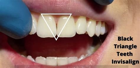 Black Triangle Teeth Invisalign What You Should Know