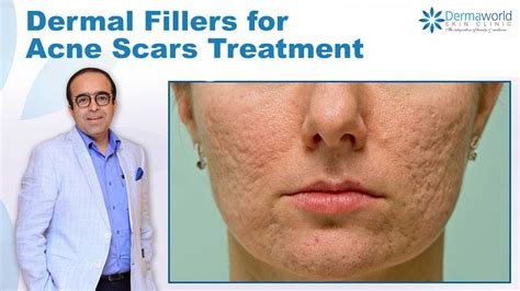Dermal Fillers For Acne Scars Treatment