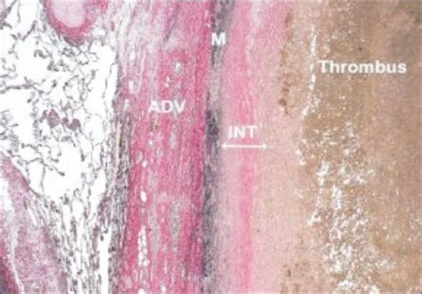 Histopathology Images Of Pulmonary Vascular Disease Hilar Elastic