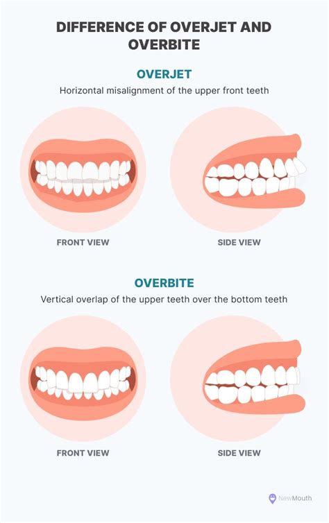 Overbite Vs Overjet Understanding The Differences