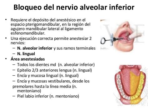 Anestesias Intraorales