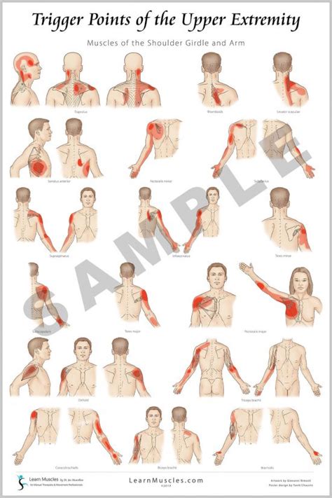 Trigger Point Upper Extremity 24 X 36 Premium Poster 2 Pack Learn