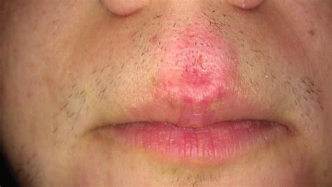 How To Get Rid Of Acne On Your Upper Lip Quivering Help