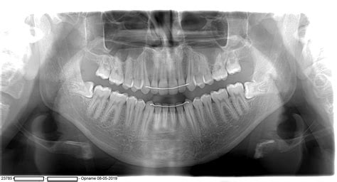Will The Removal Of My Two Wisdom Teeth On The Bottom Cause Any Visible