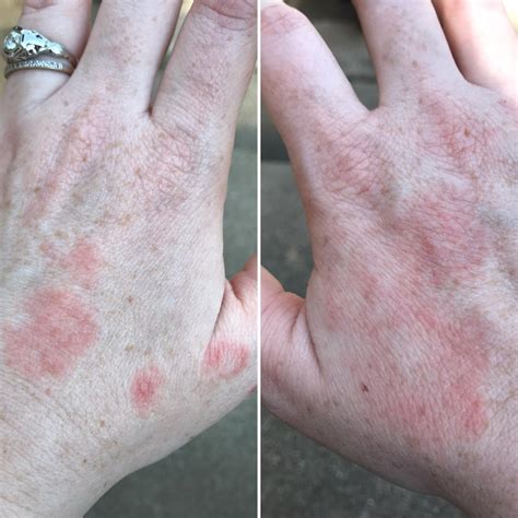 Does This Look Like A Lupus Hand Rash Lupus
