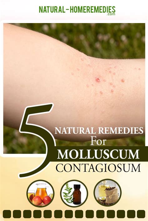 5 Natural Cures For Molluscum Contagiosum How To Cure Molluscum