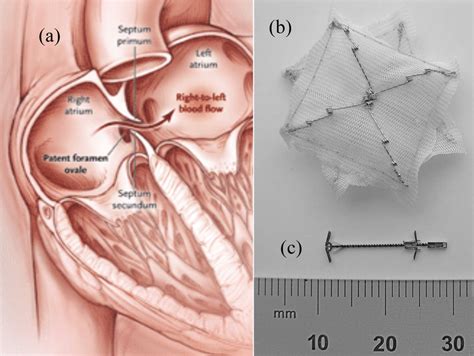 Patent Foramen Ovale Pfo And Closure Devices A Pfo