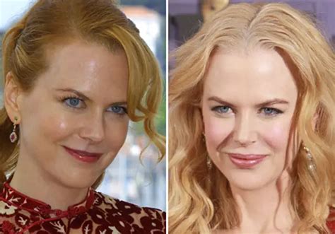 Nicole Kidman Plastic Surgery Before And After Botox Injections Celebie