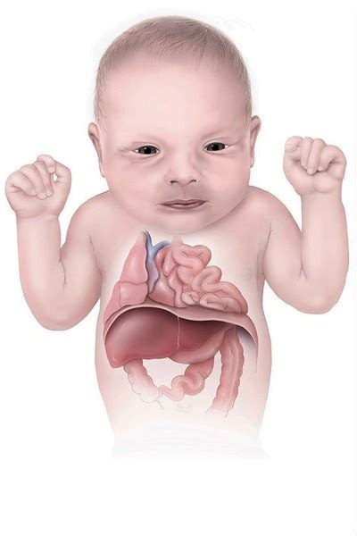 Congenital Diaphragmatic Hernia Medlineplus Genetics