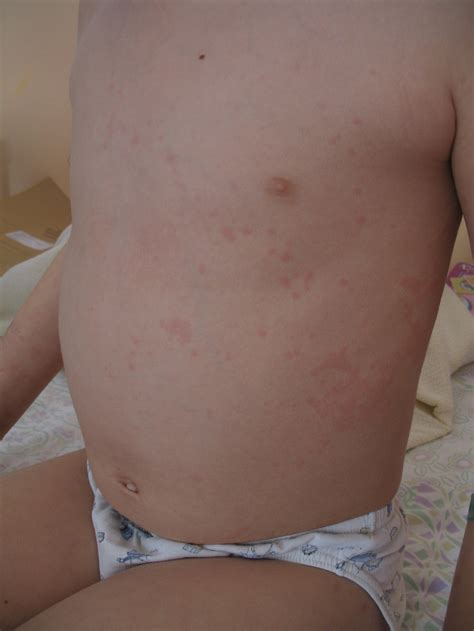 Evanescent Non Fixed Erythematous Rash In An Sjia Patient