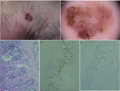 Dermoscopic Features Of Acral Lentiginous Melanoma In Situ Chinese