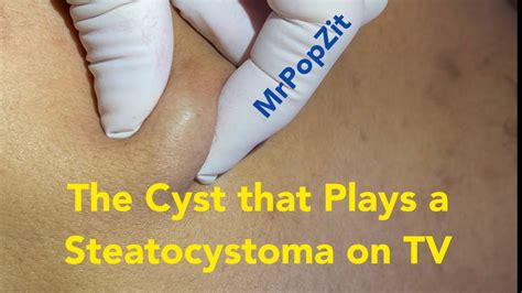 The Cyst That Plays A Steatocystoma On Tv Juicy Cyst Pop And Removal