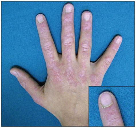 Gottron Papules A Pathognomonic Sign Of Dermatomyositis Cmaj