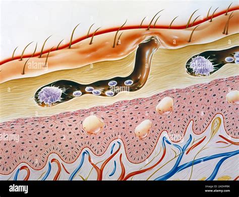 Scabies Mites Burrowing In The Top Layer Epidermis Of Human Skin