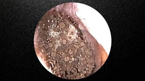 Severe Fungal Infection Otomycosis Ear Cleaning Youtube