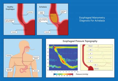 High Resolution Esophageal Manometry