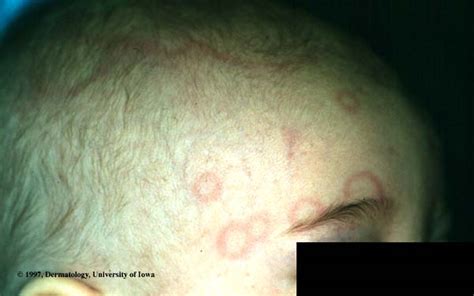 Erythema Annulare Of Infancy Department Of Dermatology