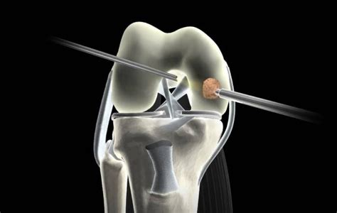 Knee Arthroscopy Surgery Rehab Protocol And Recovery Time
