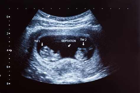 First Semi Identical Twins Identified In Pregnancy Nejm