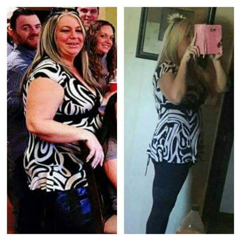 Lori Dyas Reboots Her Health And Life After Weight Loss Surgery Success Prime Surgicare