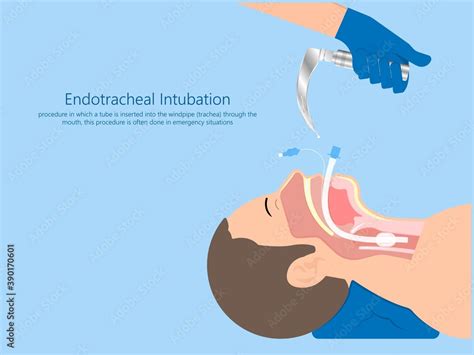 Vettoriale Stock Endotracheal Intubation Icu Care Unit Covid 19 Larynx