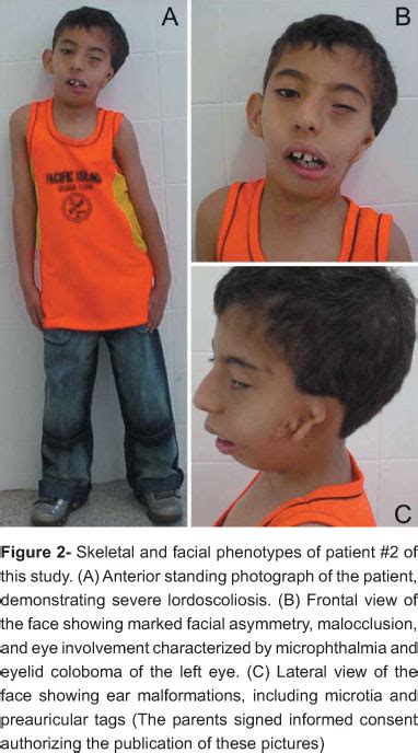 SciELO Brasil Goldenhar Syndrome Clinical Features With Orofacial Emphasis Goldenhar