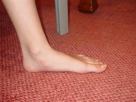 Flat Feet Symptoms Causes And Risk Factors Home Remedy