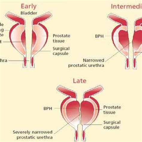 Pathophysiology Of Benign Prostatic Hyperplasia Sexiezpicz Web Porn