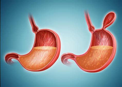 Stomach With And Without Hernia Photograph By Pixologicstudio