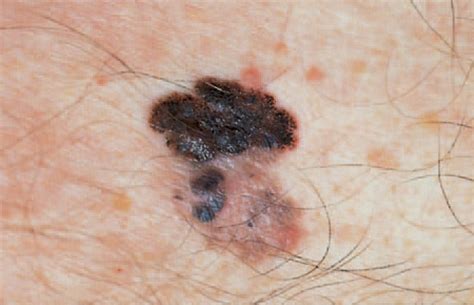 Skin Cancer Photos Melanoma