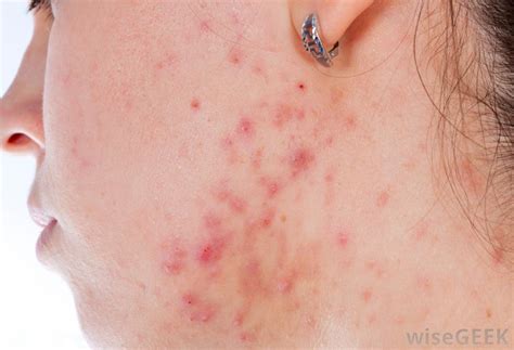 What Are The Most Common Causes Of Facial Rashes