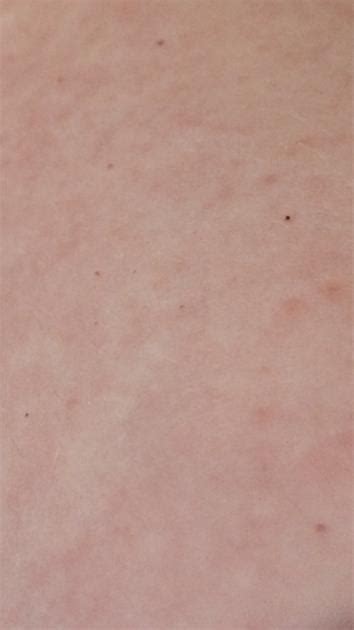Little Red Spots On Skin Looks Like Blood
