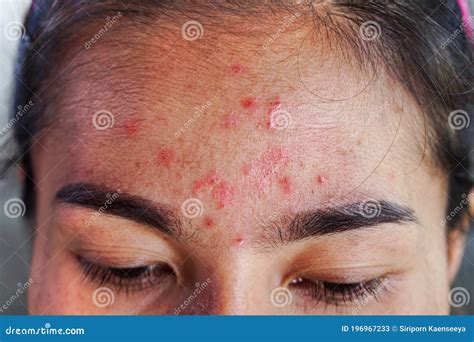 Closeup Acne On Forehead Of Asian Woman Teen Face With Rash Skin